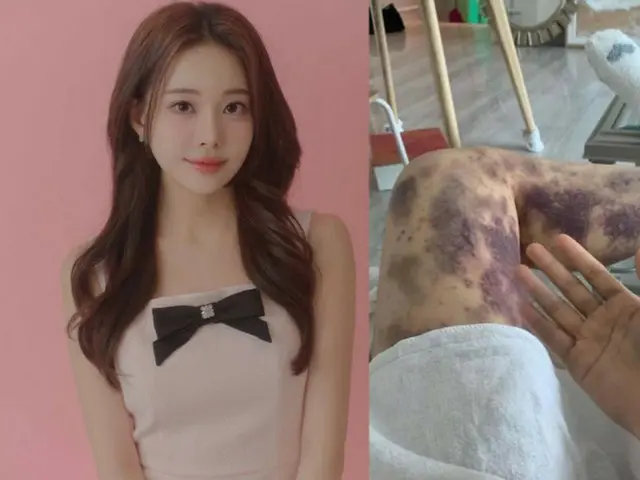 YouTuber populer menang gugatan atas memar di sekujur tubuh setelah disuntik dokter kulit di Korea Selatan
